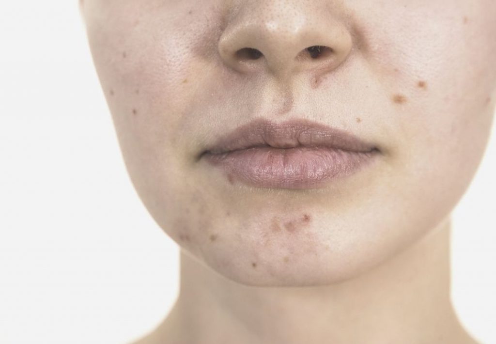 tratamiento acne